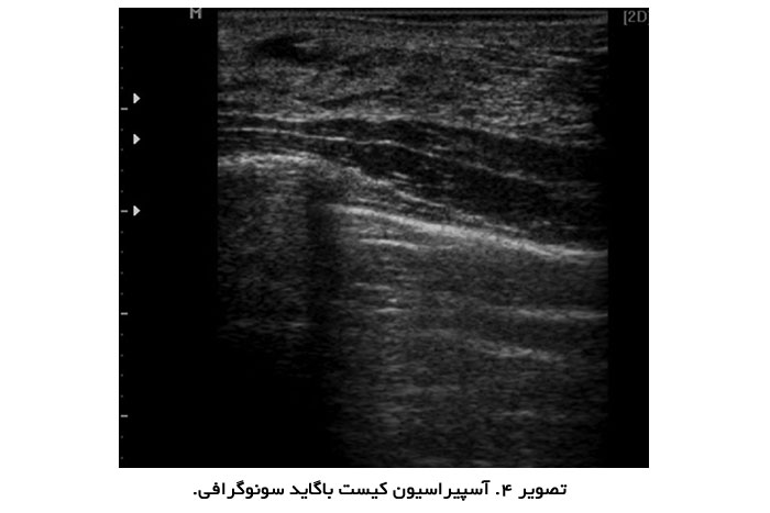 آسپيراسيون کيست باگايد سونوگرافی